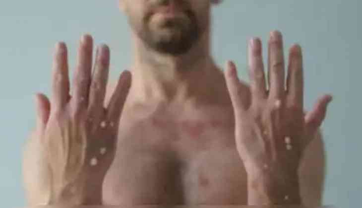 Symptoms of Monkeypox